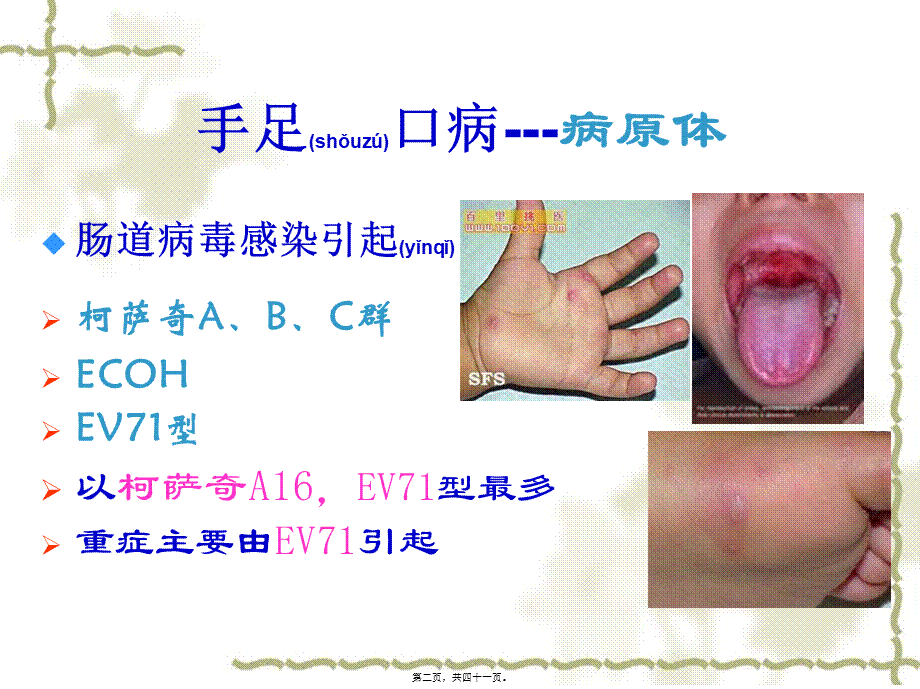 2022年医学专题—手足口病重症诊治中的相关问题(钱素云).ppt_第2页