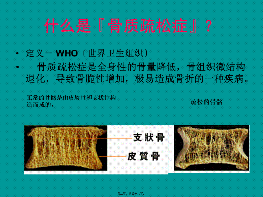 关节痛之骨质疏松.pptx_第2页