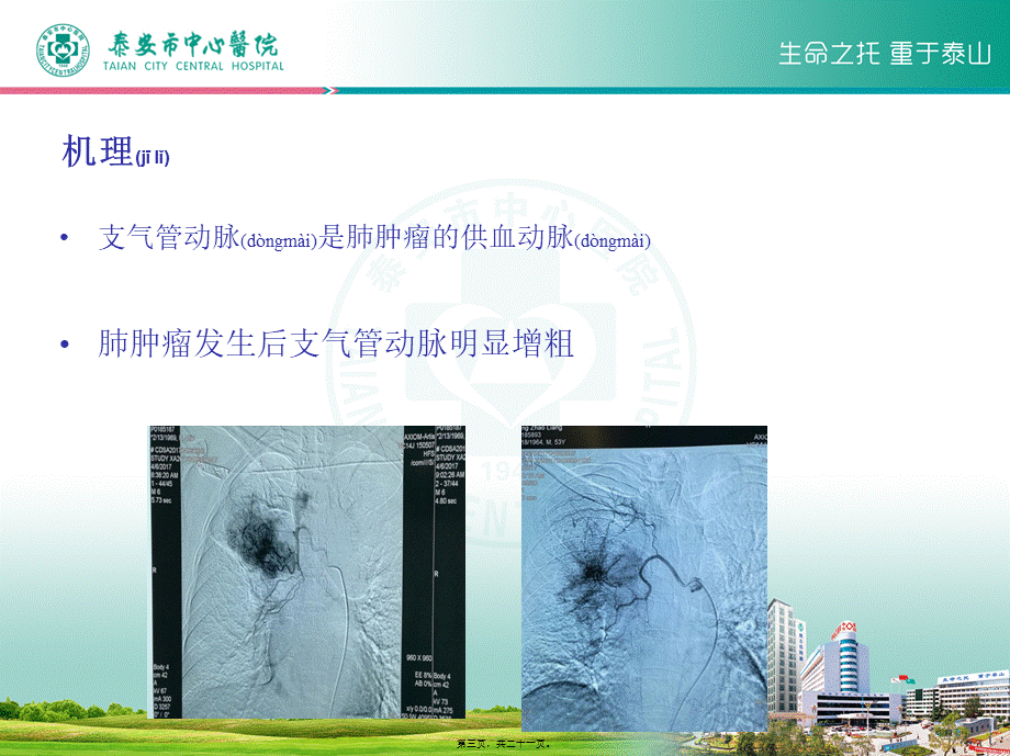 2022年医学专题—肺癌支气管动脉化疗栓塞术-教学查房.ppt_第3页