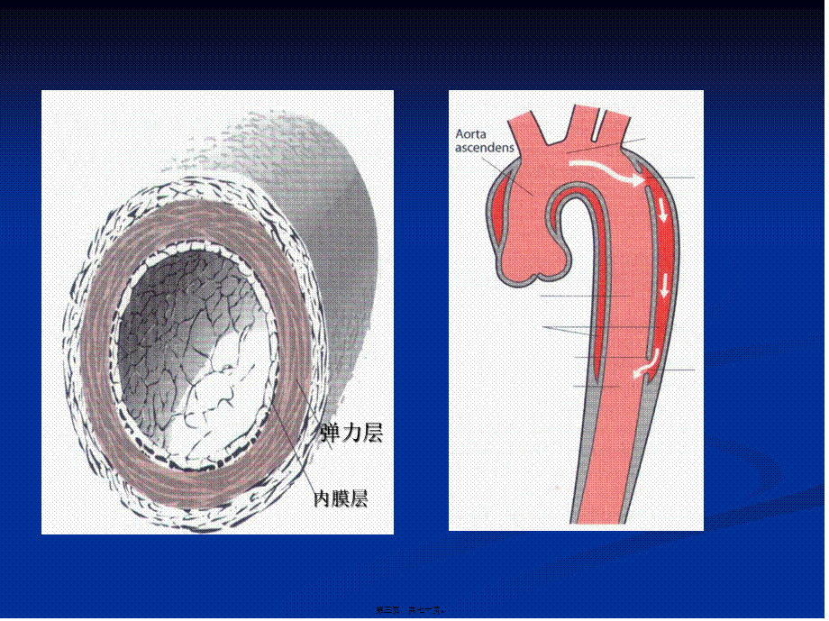 主动脉夹层动脉瘤.pptx_第3页