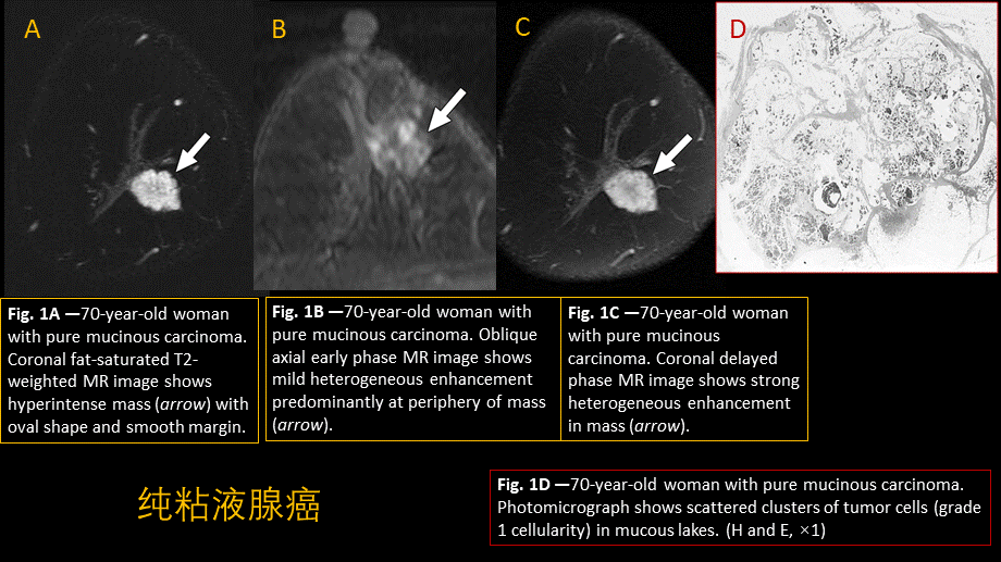 乳腺粘液腺癌MR与病理特点(1).pptx_第2页