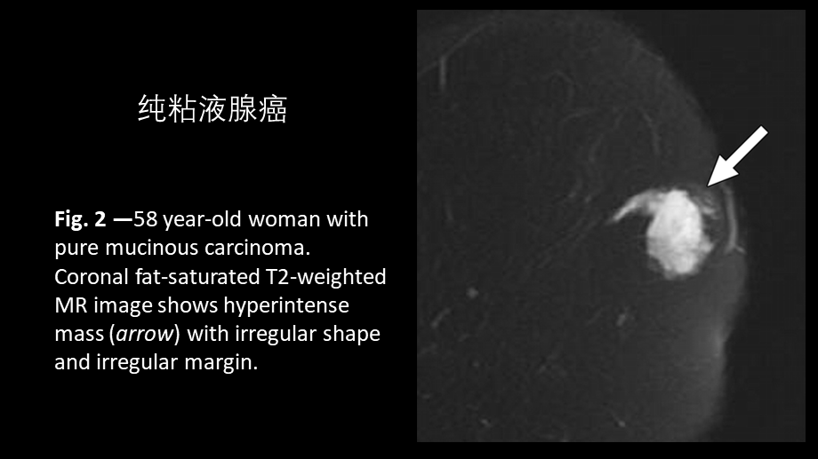 乳腺粘液腺癌MR与病理特点(1).pptx_第3页