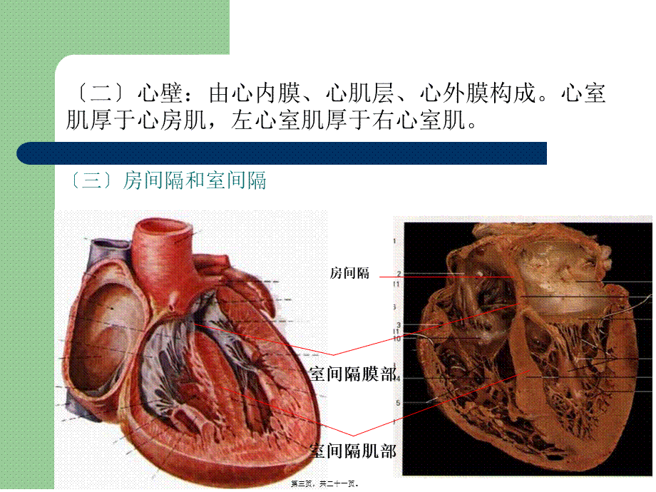 七-心脏粘液瘤.pptx_第3页