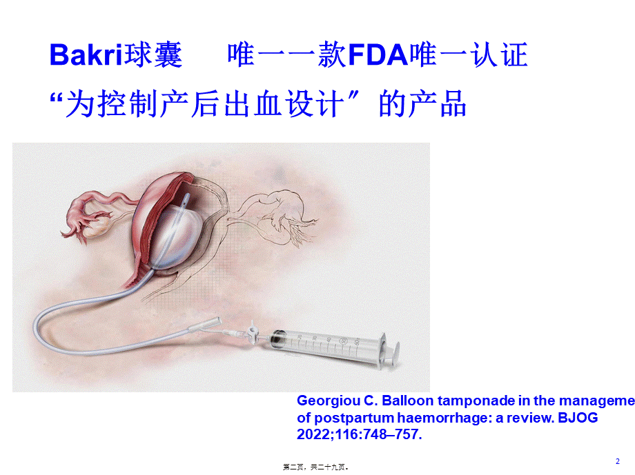 BAKRI子宫填塞球囊导管.pptx_第2页