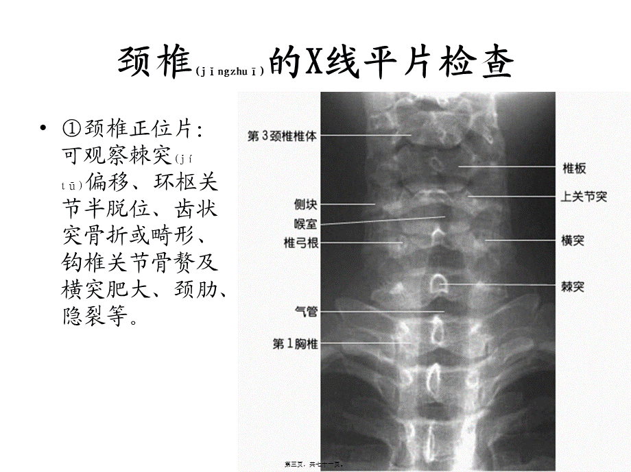 2022年医学专题—如何看颈腰椎X光片.ppt_第3页