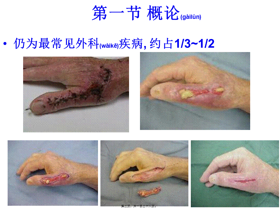 2022年医学专题—第十一章外科感染.ppt_第2页