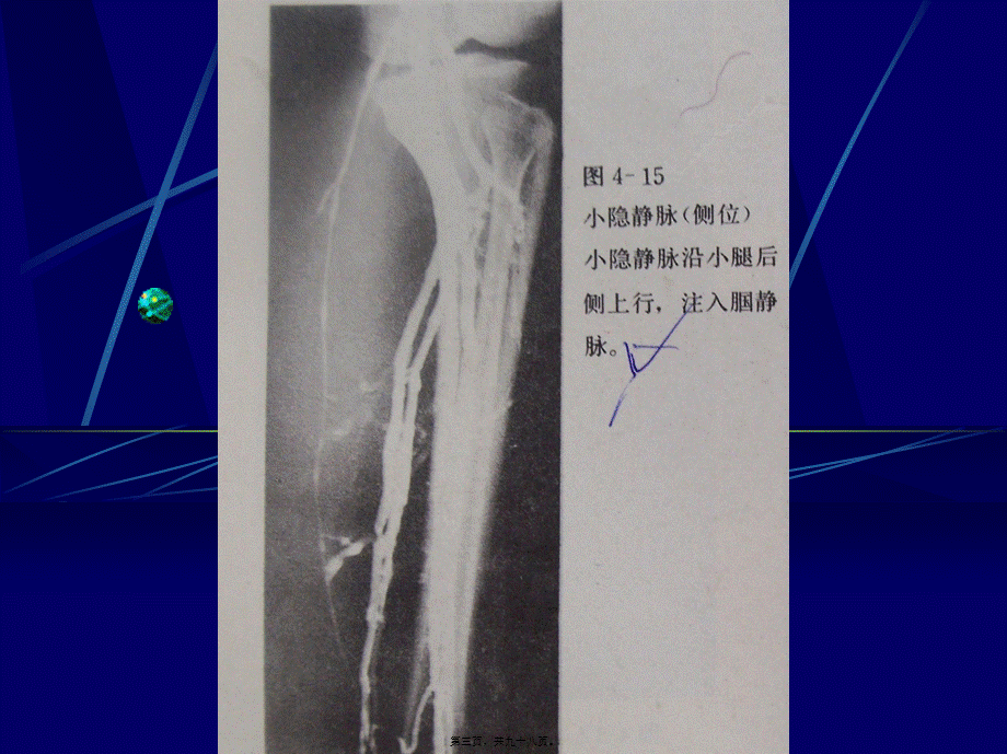 下肢静脉造影幻灯.pptx_第3页