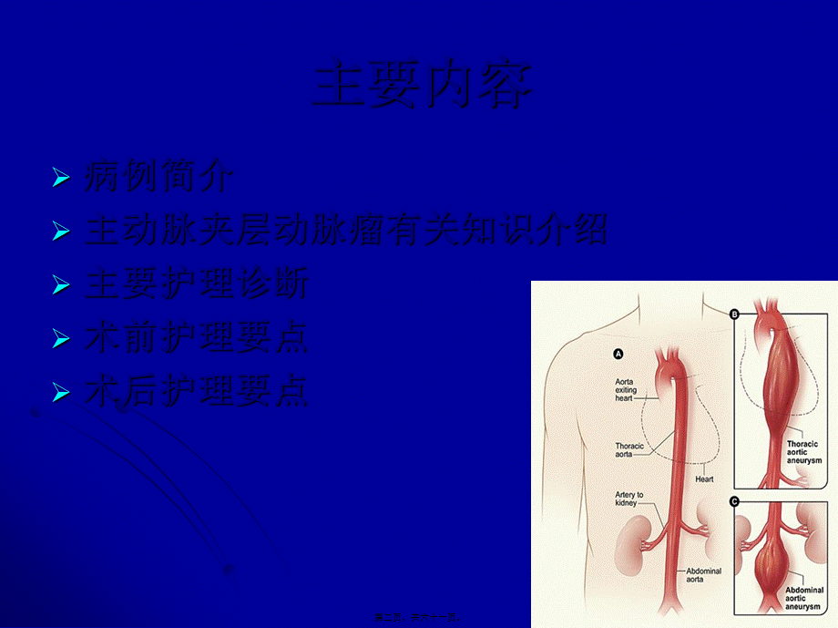 主动脉夹层动脉瘤围手术期教学查房.pptx_第2页