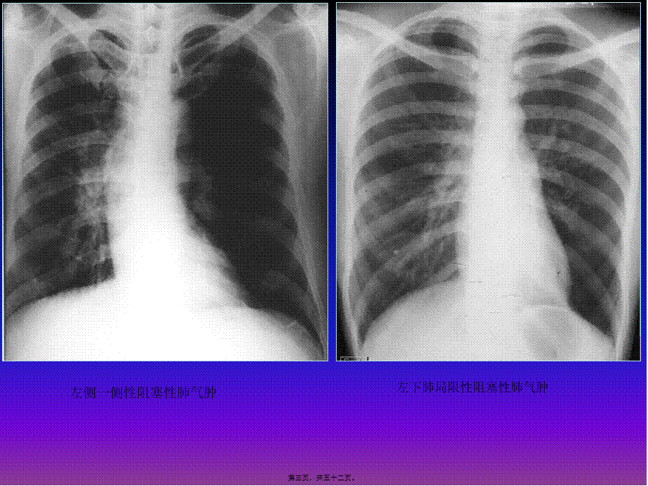 呼吸系统X线基本病变.pptx_第3页