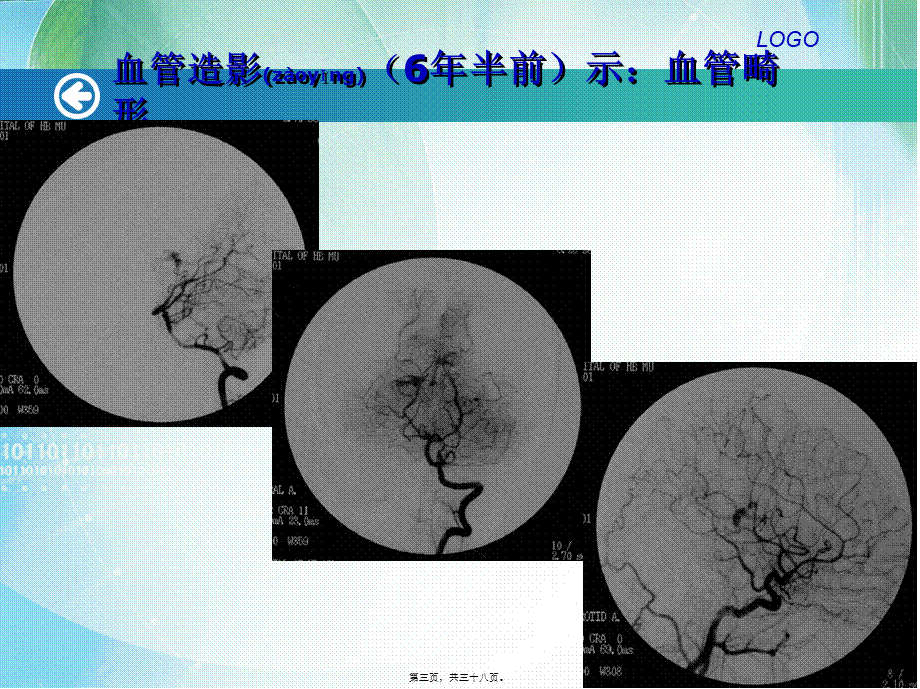 2022年医学专题—第06篇-丘脑病变2例分析.ppt_第3页