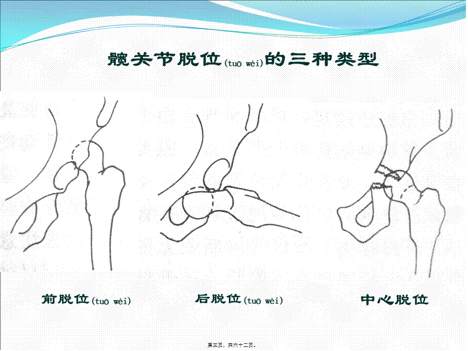 2022年医学专题—下肢骨关节损伤.ppt_第3页