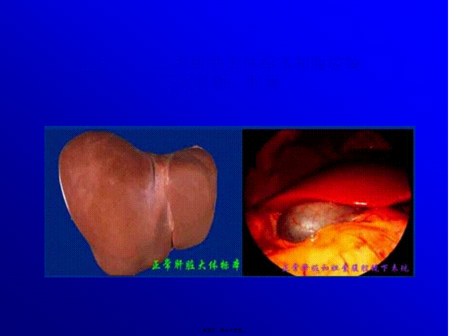 2022年医学专题—肝衰--2011122.ppt_第3页