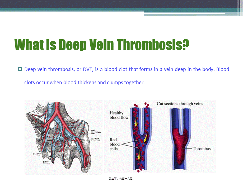 Deep-vein-thrombosis深静脉血栓.pptx_第3页