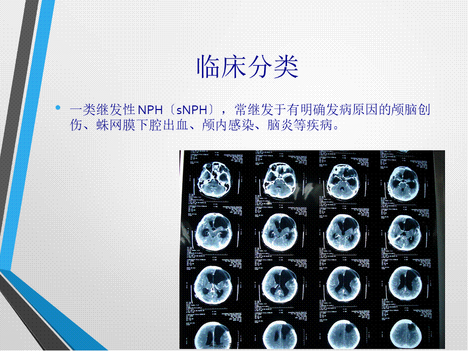 中国特发性正常压力脑积水诊治专家共识(2016).pptx_第3页