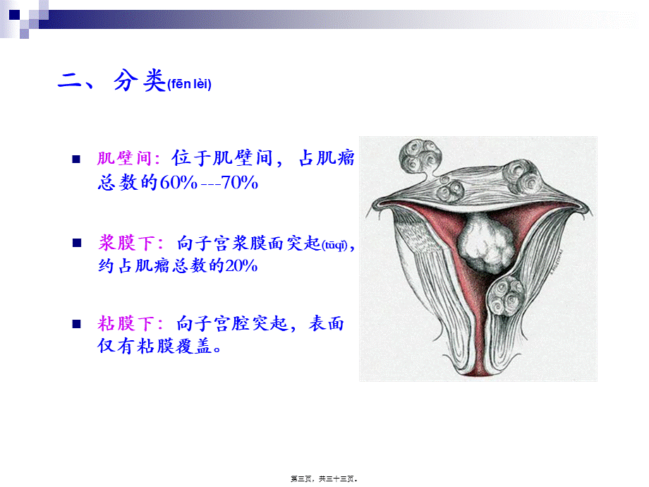 2022年医学专题—子宫肌瘤和子宫颈癌.ppt_第3页