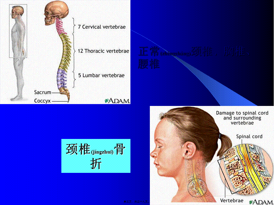 2022年医学专题—脊柱骨折与脊髓损伤.ppt_第3页