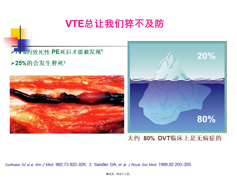 下肢深静脉血栓讲课.pptx_第3页