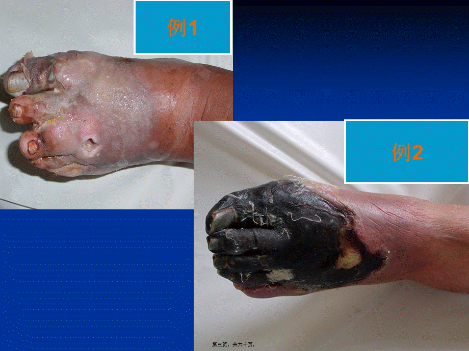 《糖尿病足》-PPT文档.pptx_第3页