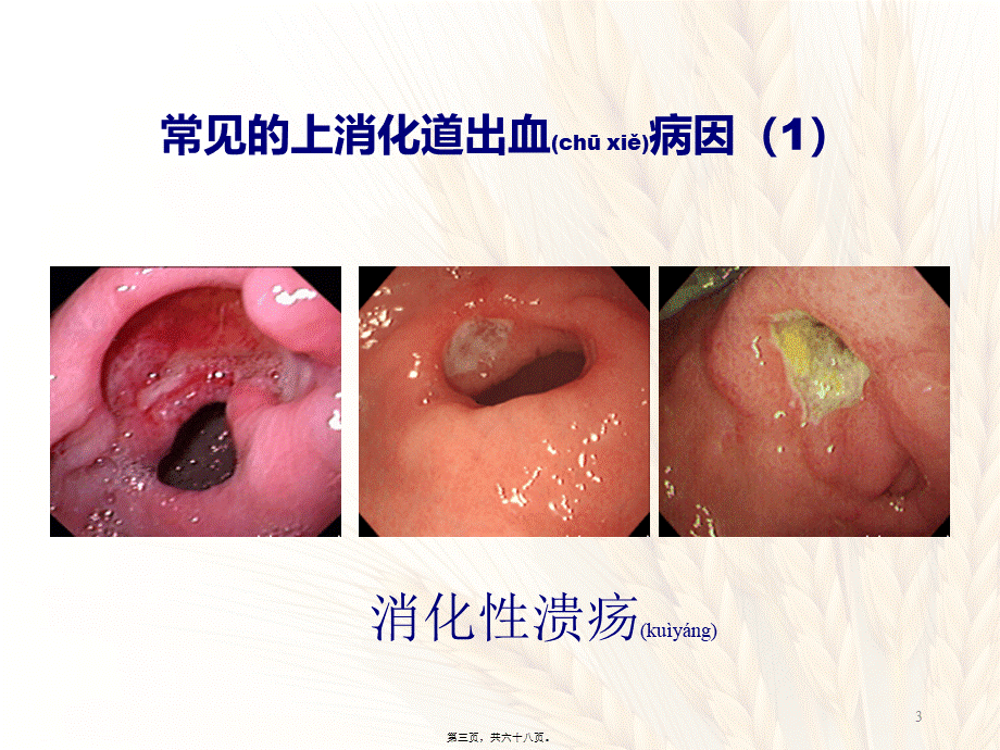 2022年医学专题—上消化道出血的诊治思维.ppt_第3页