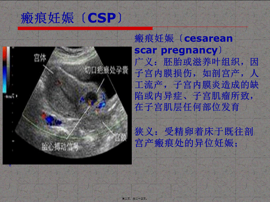 子宫瘢痕妊娠...pptx_第2页