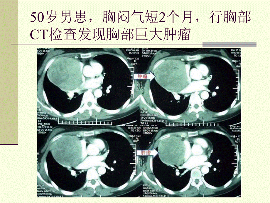 154肿瘤科-纵隔肿瘤(1).ppt_第2页