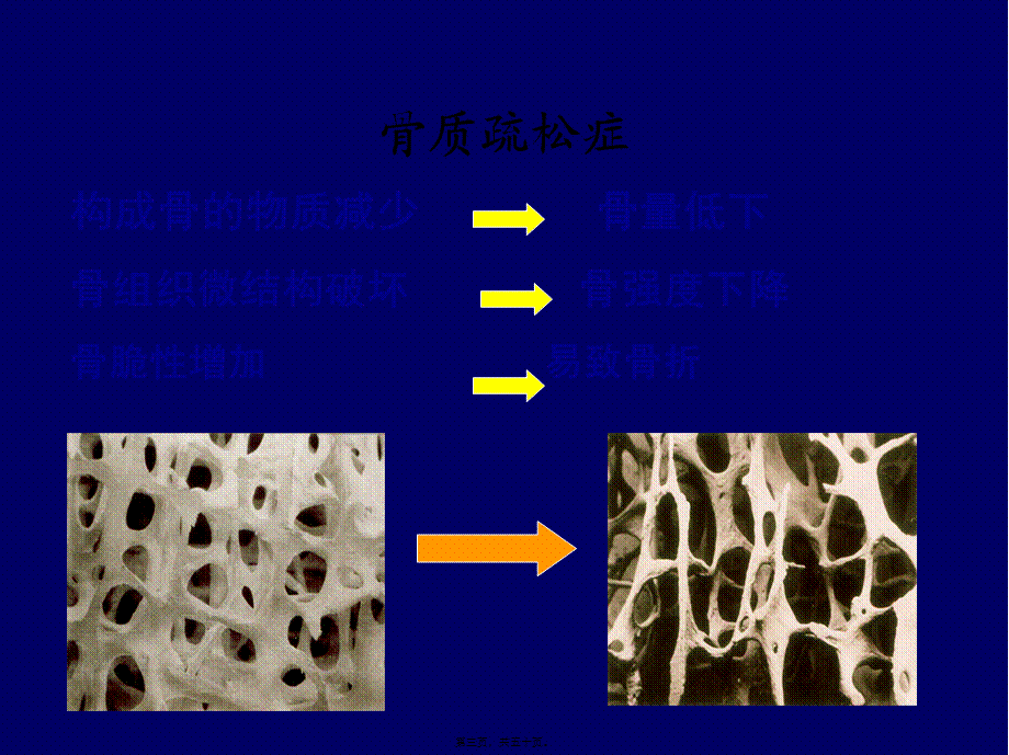 4.内分泌-2.骨质疏松症.pptx_第3页