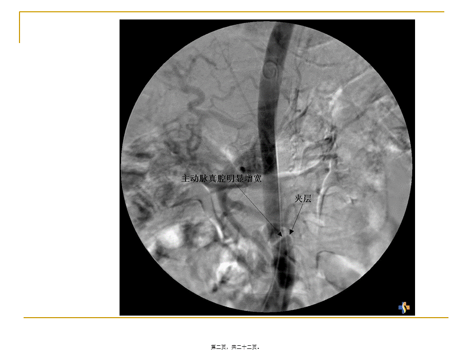 主动脉夹层剖析.pptx_第2页