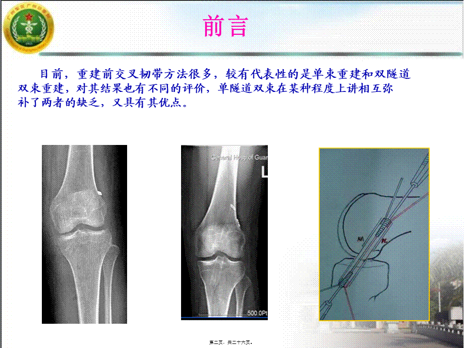 单隧道双束前交叉韧带重建的中期疗效观察.pptx_第2页