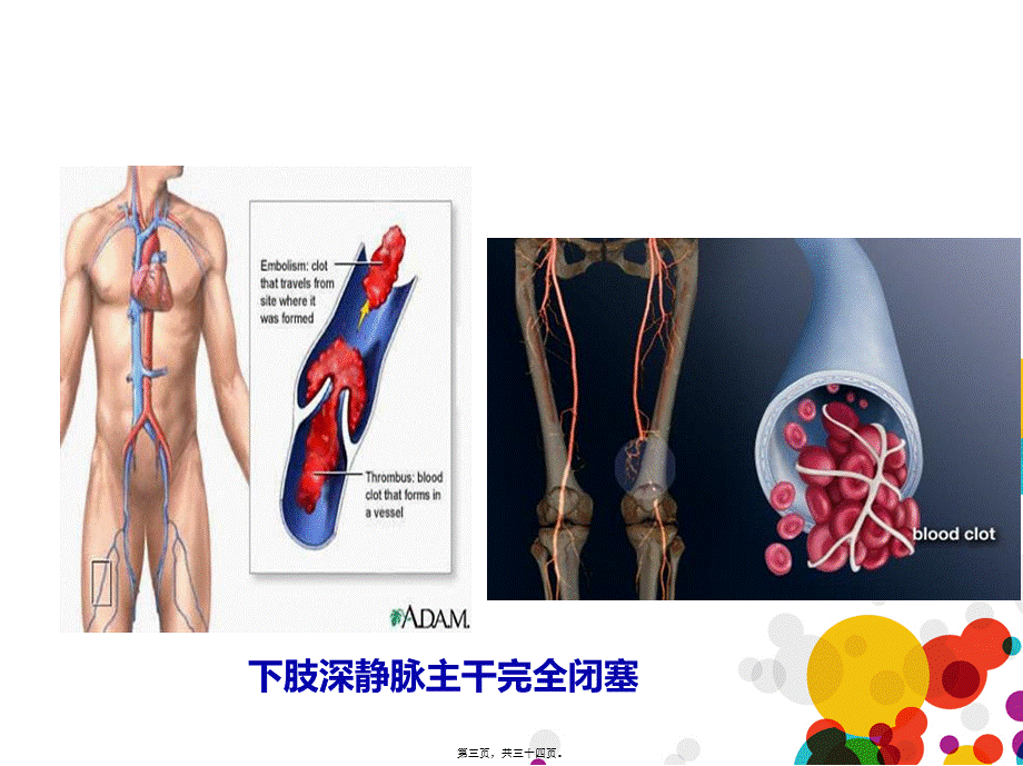 下肢深静脉血栓(成稿).pptx_第3页