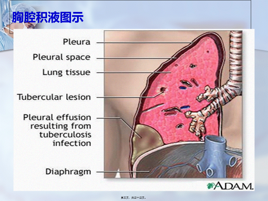 三大穿刺术(胸穿、腹穿、腰穿).pptx_第3页