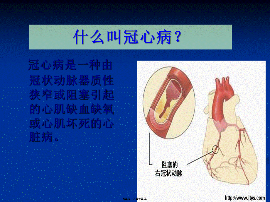 冠心病-2.pptx_第3页