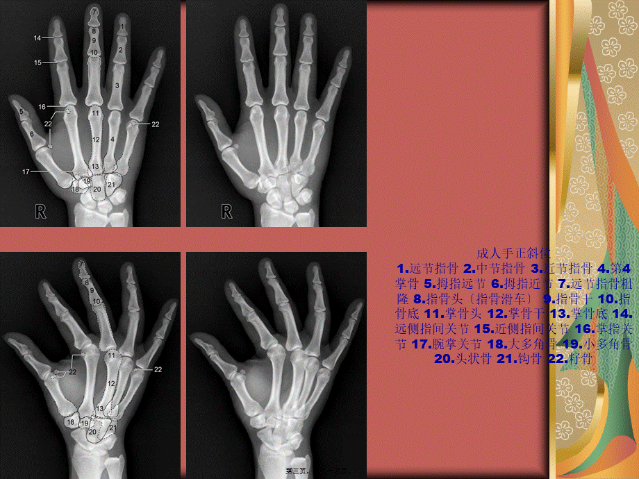 四肢关节正常变异、常见病变及创伤的影像表现.pptx_第3页