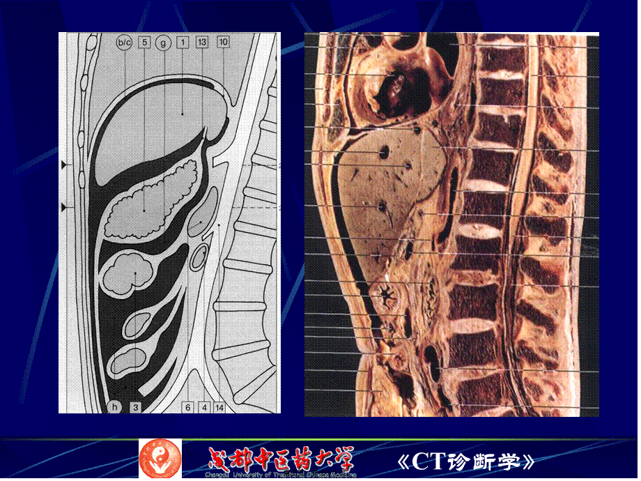 7腹膜腔、腹膜后CT检查.pptx_第3页