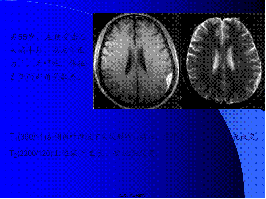 MRI图像-脑-01.pptx_第3页