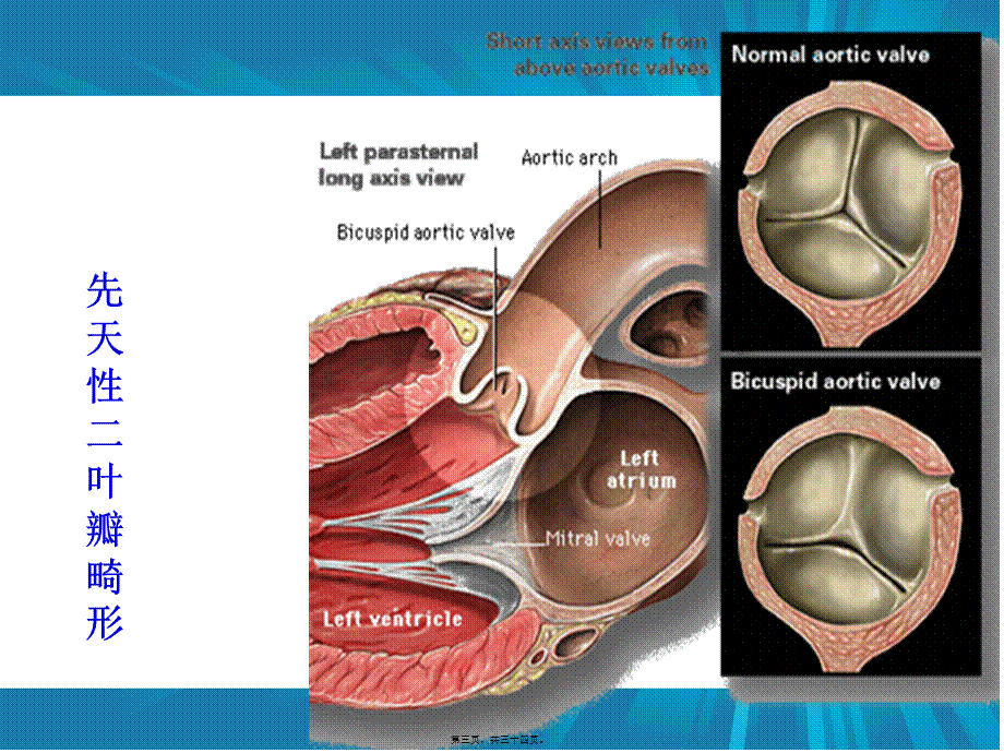 主动脉瓣+肺动脉瓣.ppt_第3页