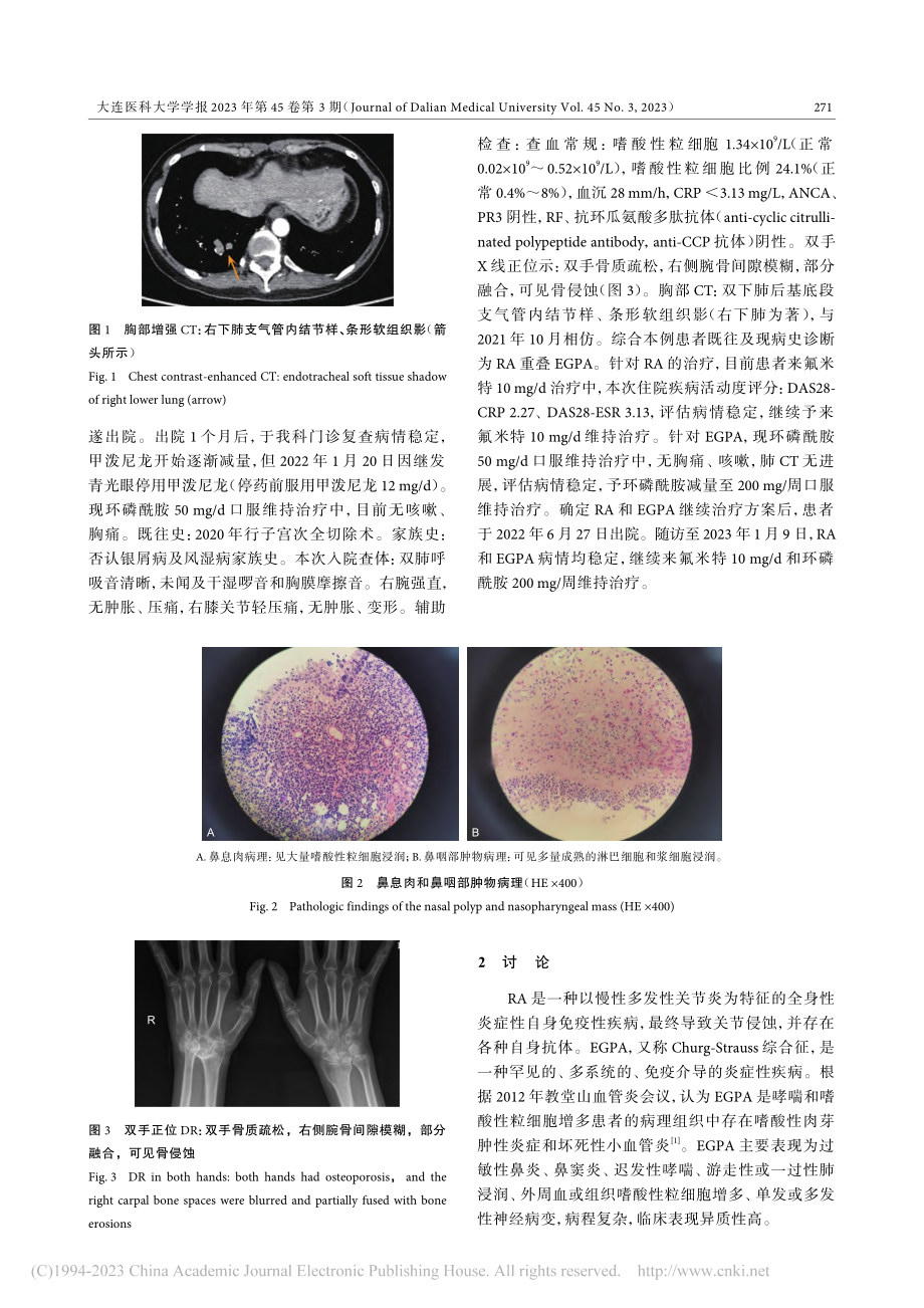 类风湿关节炎重叠嗜酸性肉芽肿性多血管炎1例_张洁文.pdf_第2页