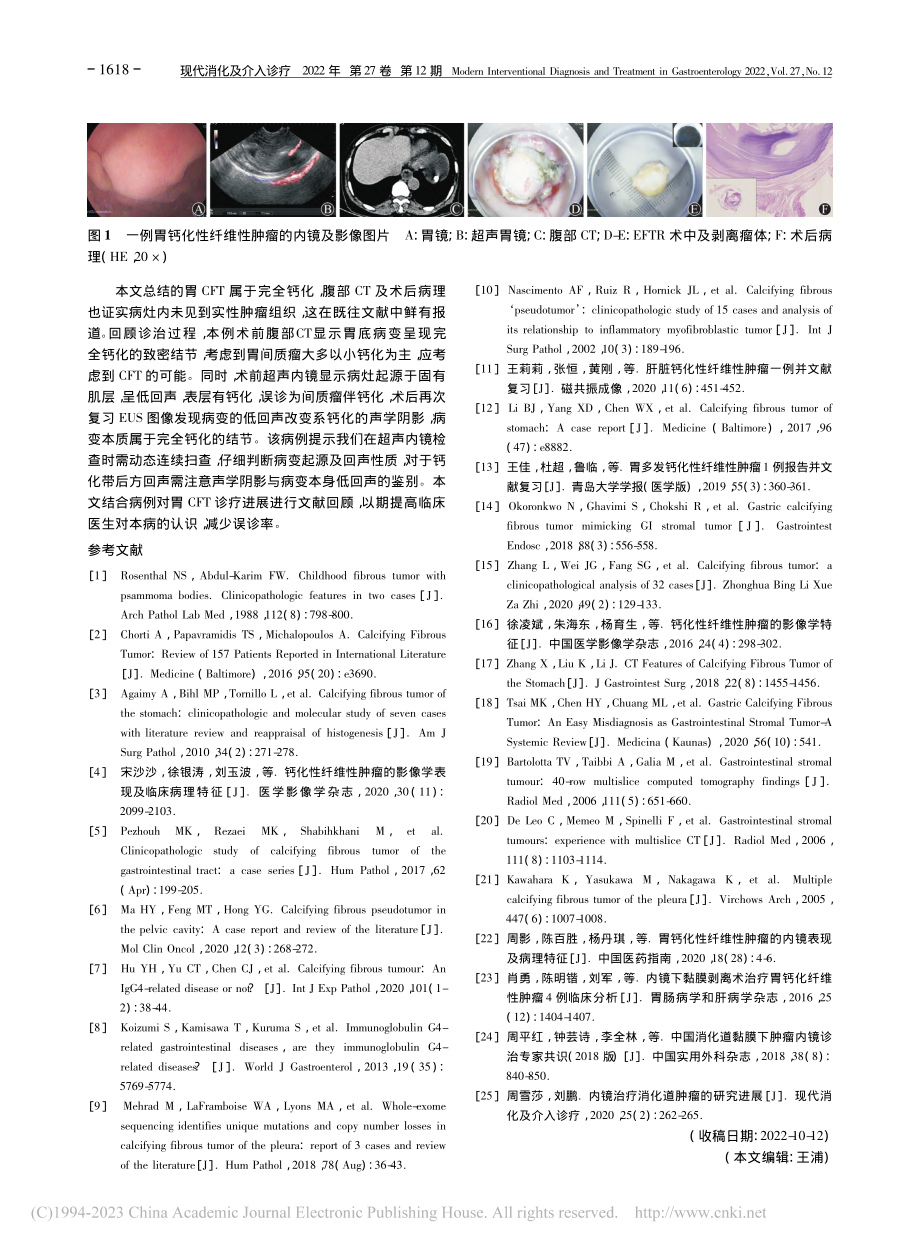 一例“骨化”的胃肿瘤_王蒙.pdf_第2页