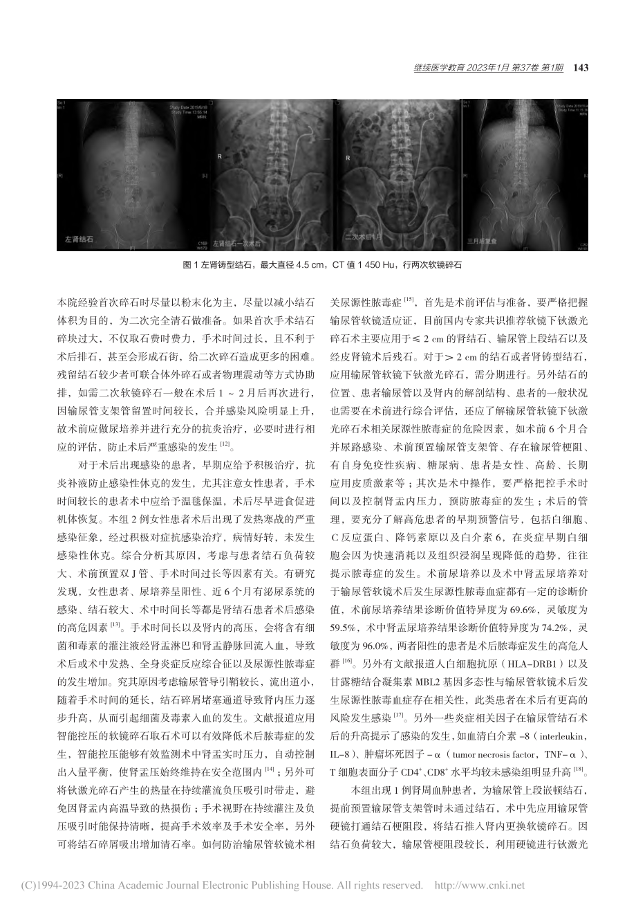 一次性电子输尿管软镜治疗上尿路结石的疗效_崔小健.pdf_第3页