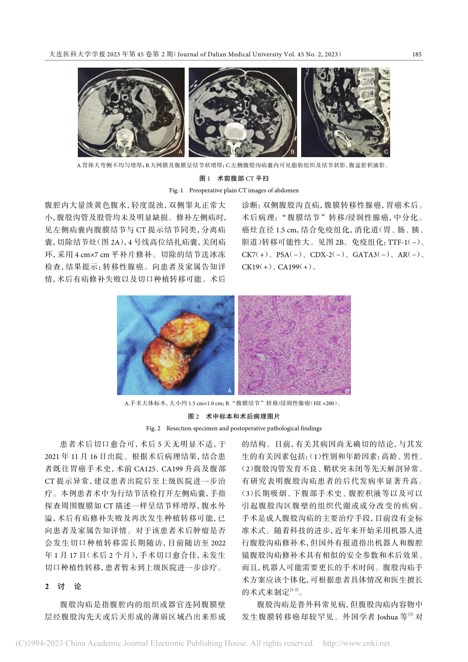 疝囊内腹膜转移性腺癌1例_宋金起.pdf_第2页