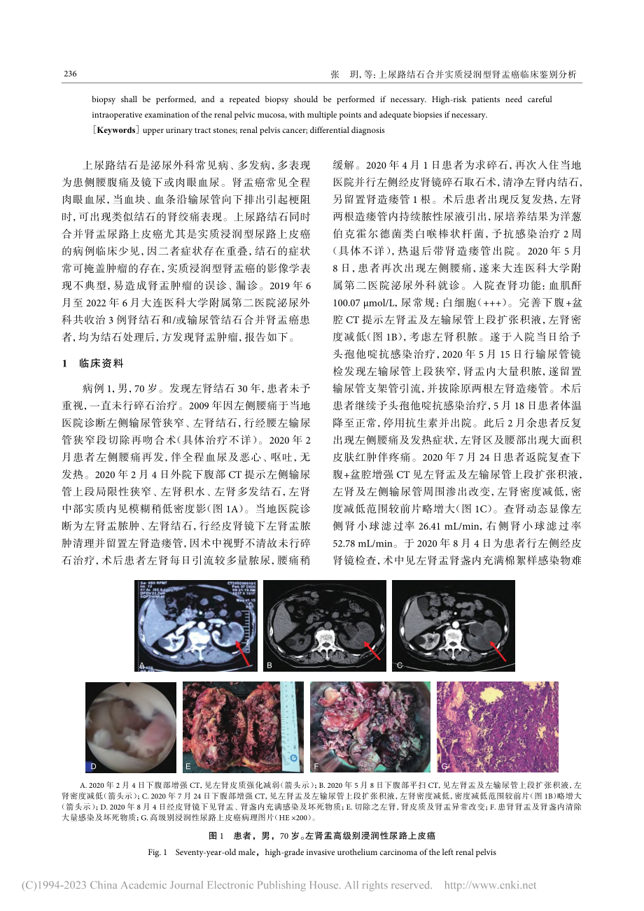 上尿路结石合并实质浸润型肾盂癌临床鉴别分析_张玥.pdf_第2页