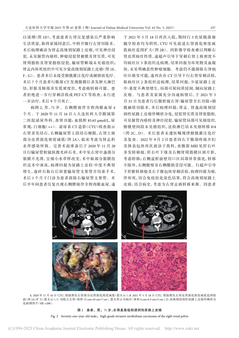 上尿路结石合并实质浸润型肾盂癌临床鉴别分析_张玥.pdf_第3页