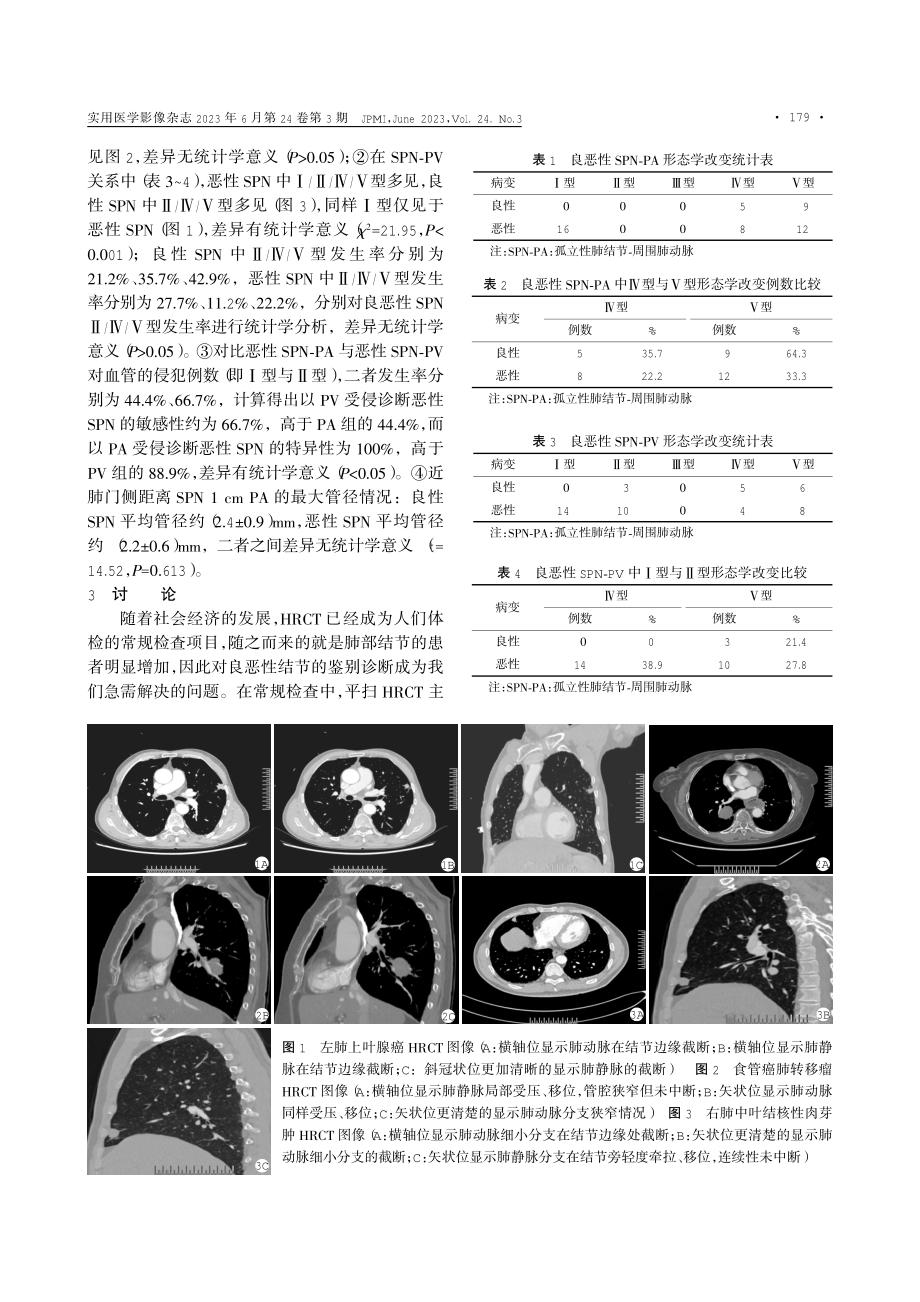 基于高分辨率CT显示孤立性肺结节与肺动静脉关系在鉴别结节良恶性中的价值研究.pdf_第3页