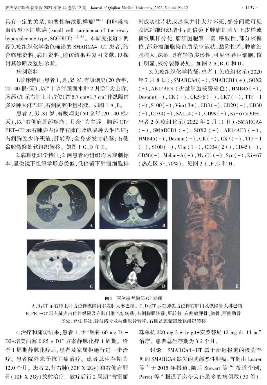 胸部SMARCA4缺失型未分化肿瘤2例.pdf_第2页