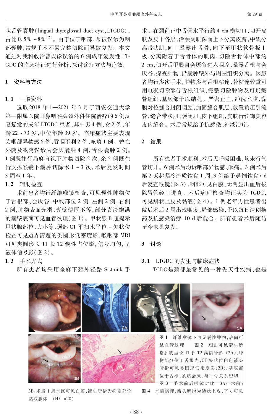 颈外径路Sistrunk手术治疗成人复发性舌甲状舌管囊肿的临床分析.pdf_第2页