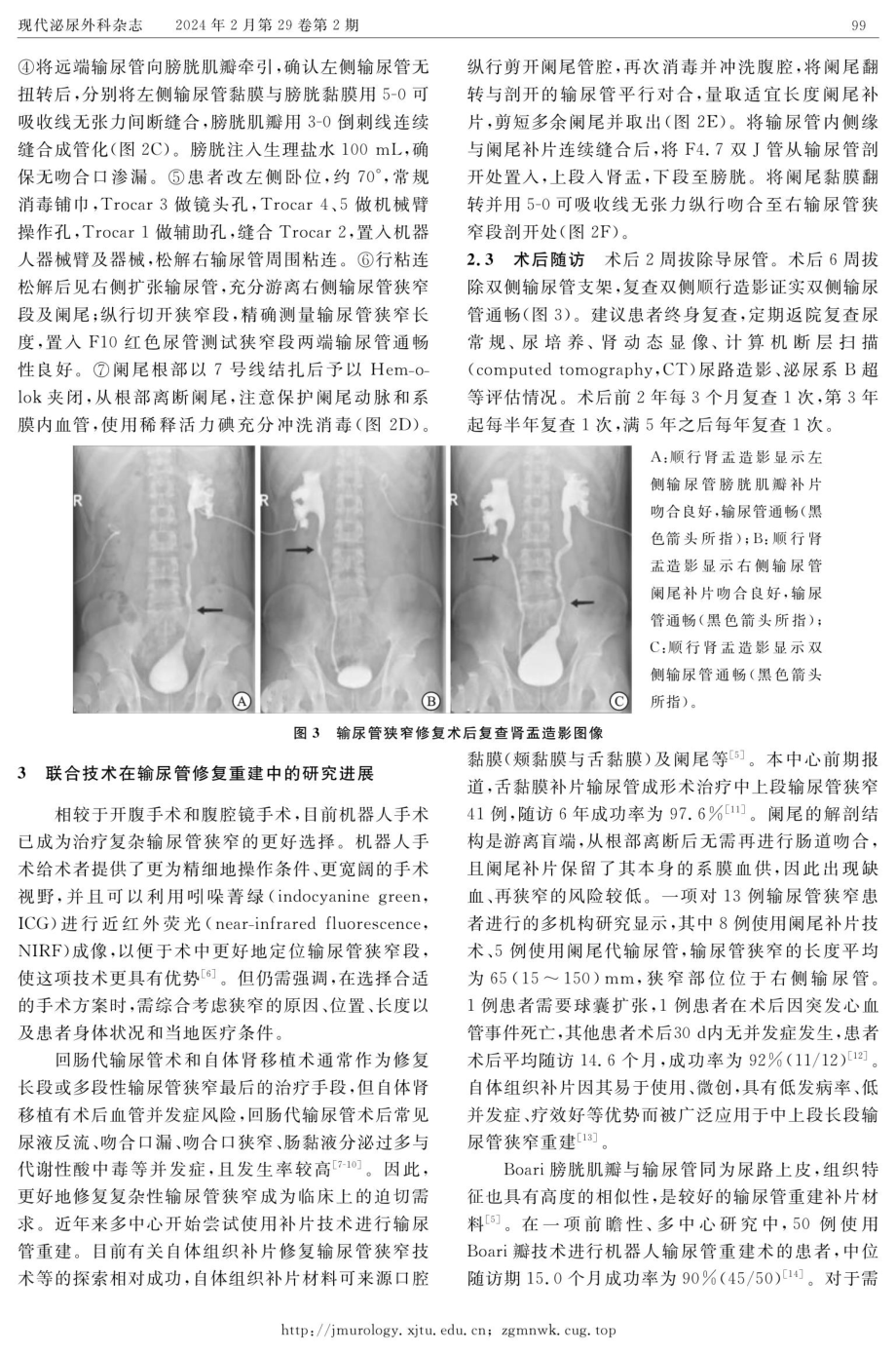 阑尾补片联合Boari膀胱肌瓣代输尿管一期修复双侧输尿管狭窄%28“大家泌尿网”观看手术视频%29.pdf_第3页