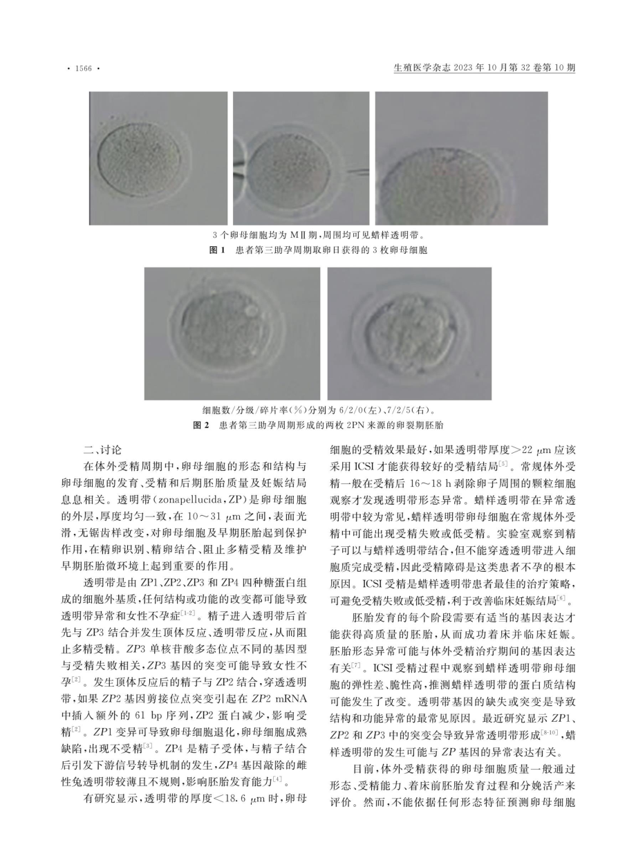 蜡样透明带卵母细胞患者ICSI助孕活产1例病例报道并文献复习.pdf_第2页